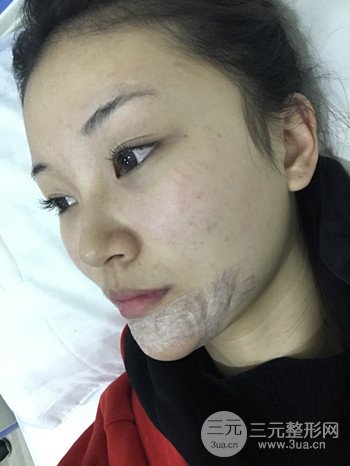 濟(jì)南硅膠假體墊下巴真人案例、下巴改變整個(gè)臉型