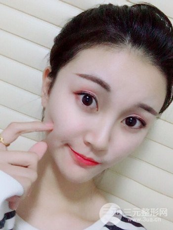 濟(jì)南硅膠假體墊下巴真人案例、下巴改變整個(gè)臉型