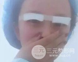 南京鼓樓譚謙醫(yī)生切開雙眼皮案例，恢復(fù)圖分享~