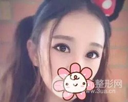 南京鼓樓譚謙醫(yī)生切開雙眼皮案例，恢復(fù)圖分享~