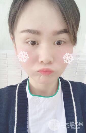 磨骨瘦臉（下頜角切除）恢復過程及前后對比照片