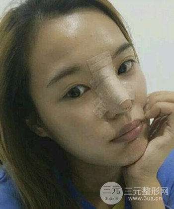 模特做隆鼻整形真實日記分享，附上恢復(fù)過程圖