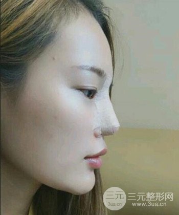 模特做隆鼻整形真實日記分享，附上恢復(fù)過程圖