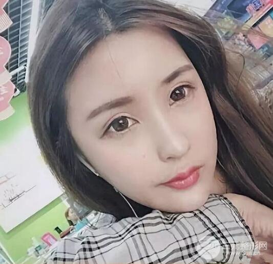 王明利自體脂肪填充案例恢復(fù)過程分享