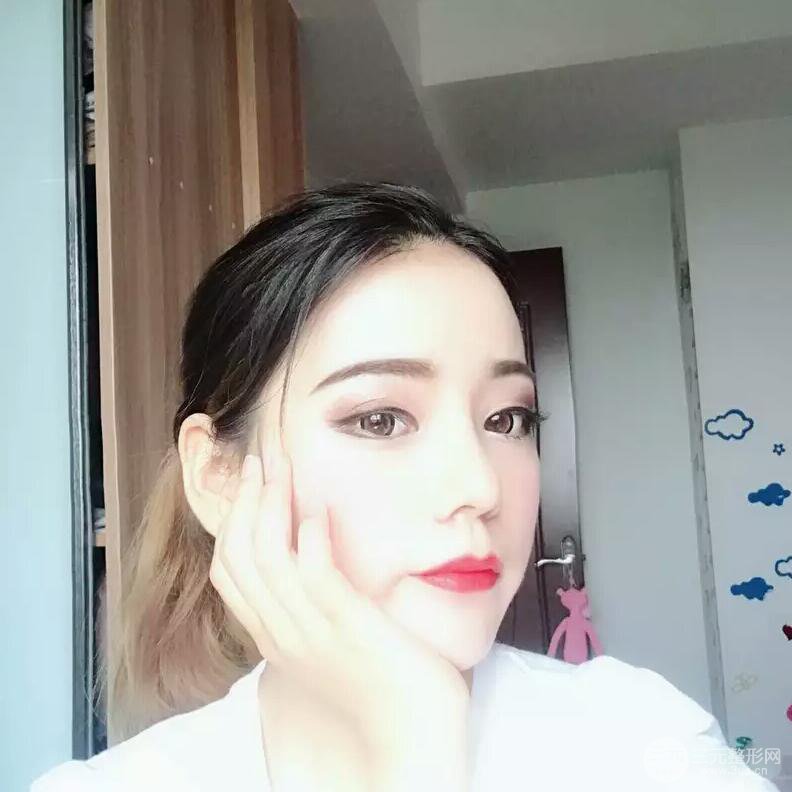 硅膠隆鼻+自體耳軟骨墊鼻尖案例前后對比照片分享