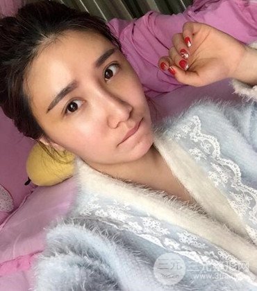 網(wǎng)絡(luò)主播做自體脂肪豐太陽(yáng)穴真實(shí)案例分享，果杠杠的