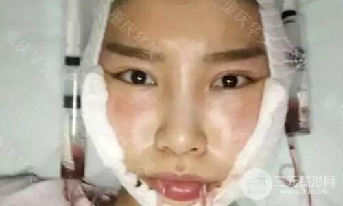 重慶華美潘寶華磨骨怎么樣?整形案例恢復(fù)圖片分享