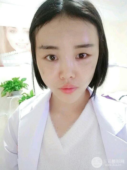 成都軍大鐘正強(qiáng)自體脂肪填充面部案例恢復(fù)圖，馬上變成“初戀臉”