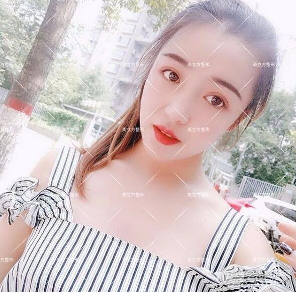 西安美立方雙眼皮怎么樣？真實(shí)案例圖片反饋~