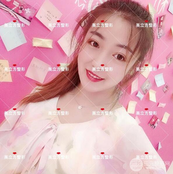 西安美立方雙眼皮怎么樣？真實(shí)案例圖片反饋~