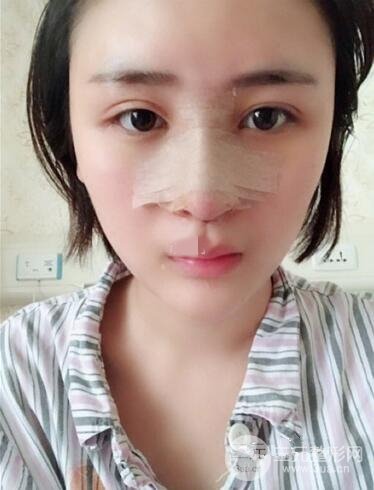 上海李鴻君隆鼻果圖片恢復(fù)日記分享