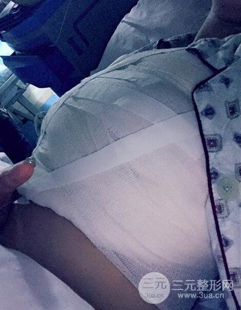 蘇州假體隆胸手術(shù)案例分享、前后對比圖分享