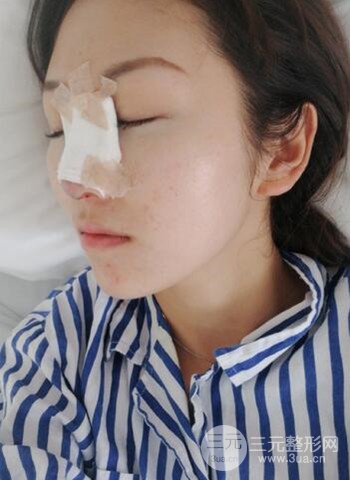 廣州隆鼻整形真實恢復(fù)期圖片，擁有精致美鼻不是夢