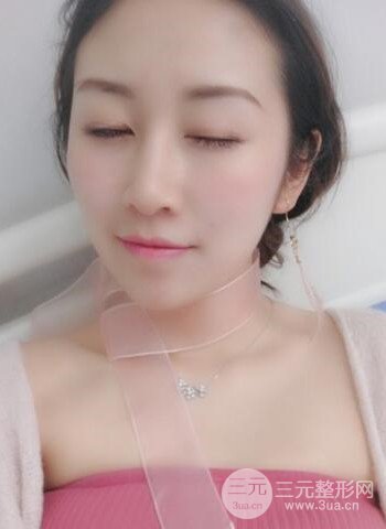 廣州隆鼻整形真實恢復(fù)期圖片，擁有精致美鼻不是夢