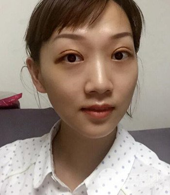 北京雙眼皮失敗修復(fù)手術(shù)日記分享，附上前后對比照片