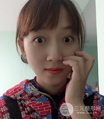 北京雙眼皮失敗修復(fù)手術(shù)日記分享，附上前后對比照片