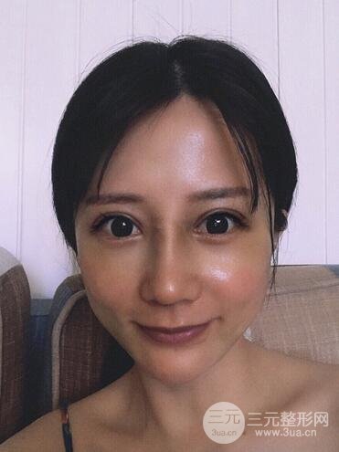 夏正義做鼻子怎么樣？隆鼻案例日記記錄