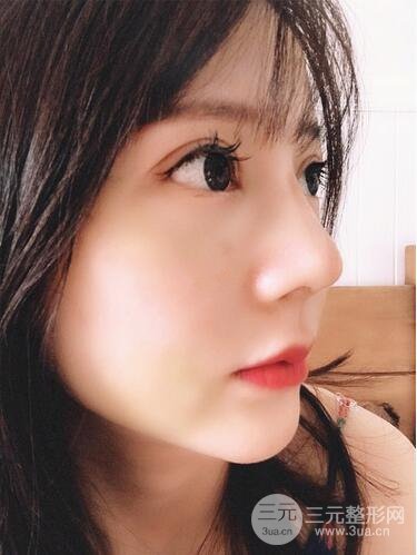 夏正義做鼻子怎么樣？隆鼻案例日記記錄