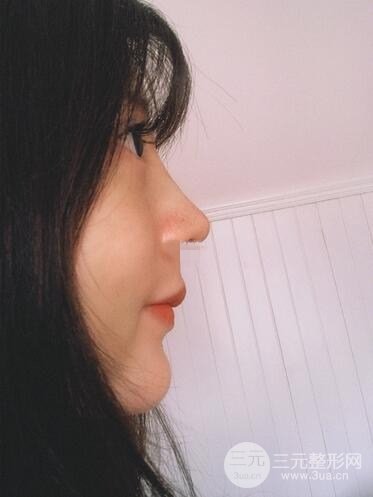 夏正義做鼻子怎么樣？隆鼻案例日記記錄