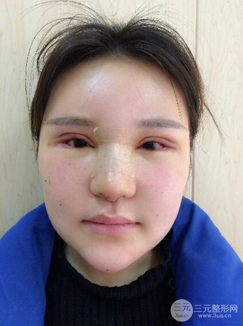 上海麗質(zhì)呂成醫(yī)生做的吸脂瘦臉日記，前后恢復(fù)圖分享