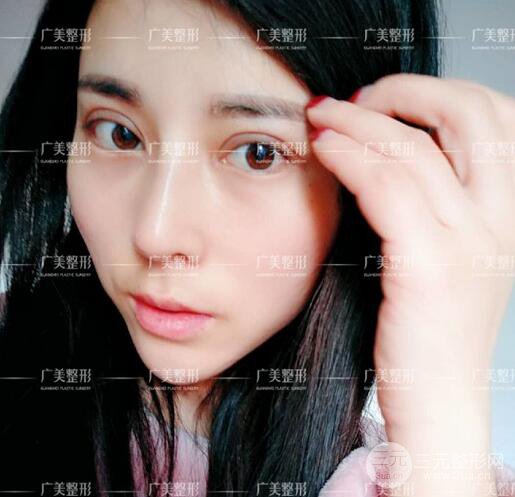 廣州廣美李曉平醫(yī)生雙眼皮整形日記分享