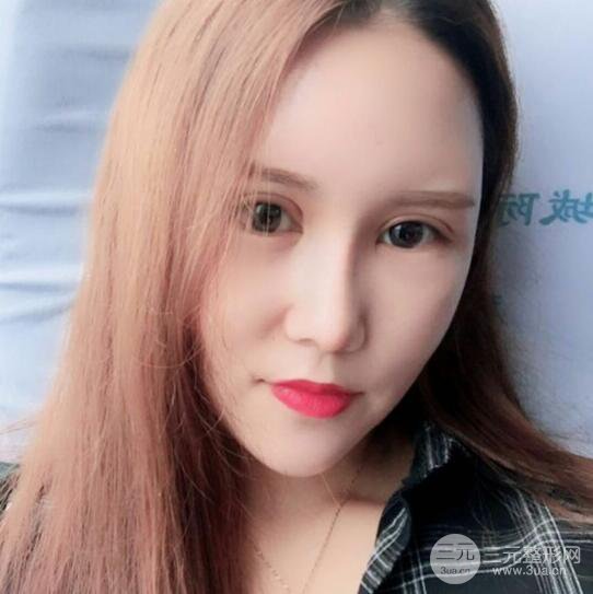 青島伊美爾國賓切開雙眼皮+隆鼻整形+硅膠墊下巴案例分享，附上前后對(duì)比照片