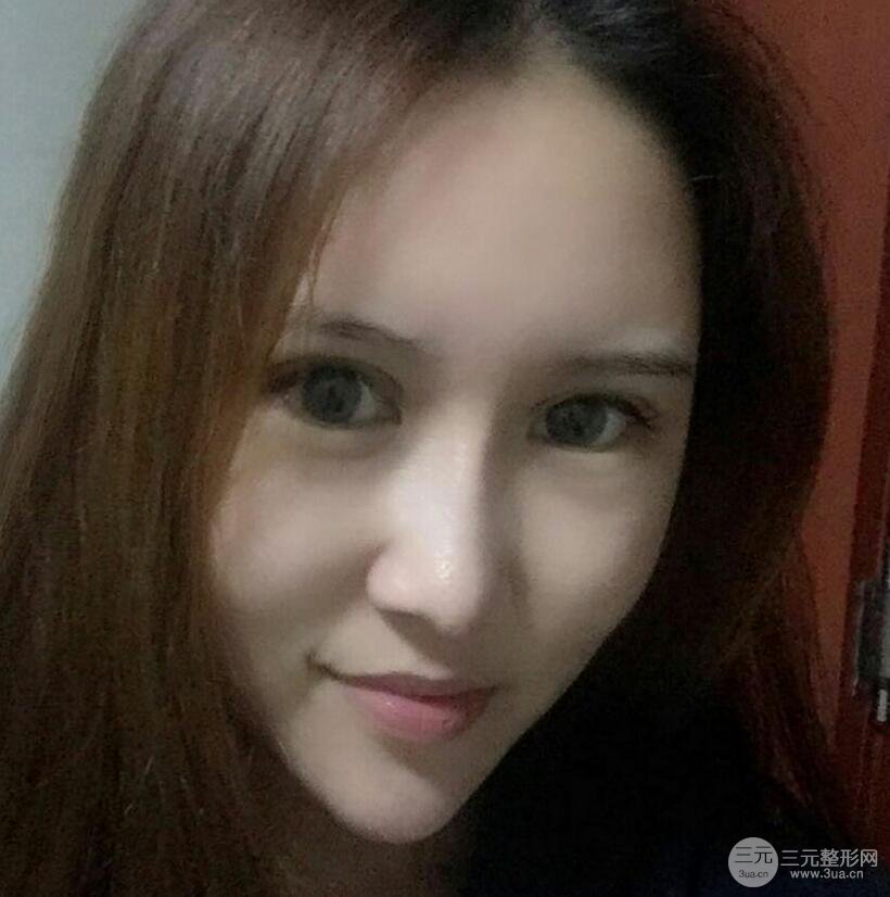 青島伊美爾國賓切開雙眼皮+隆鼻整形+硅膠墊下巴案例分享，附上前后對(duì)比照片