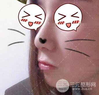 肖征剛做鼻子隆鼻案例恢復(fù)果圖日記