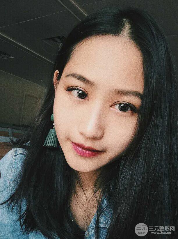 廣州曙光劉杰偉醫(yī)生切開(kāi)雙眼皮案例，前后對(duì)比圖分享