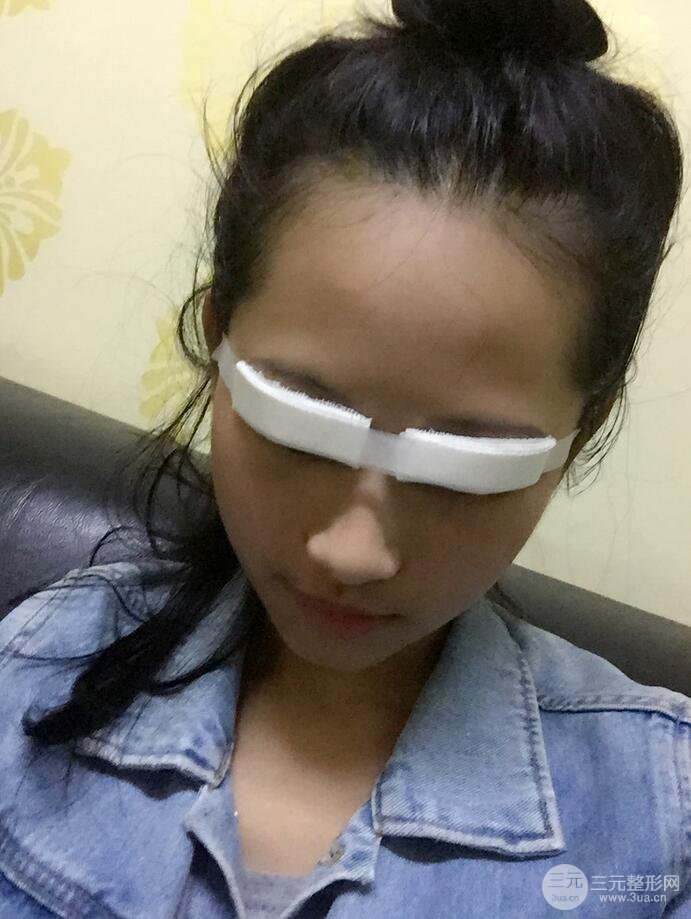 廣州曙光劉杰偉醫(yī)生切開(kāi)雙眼皮案例，前后對(duì)比圖分享