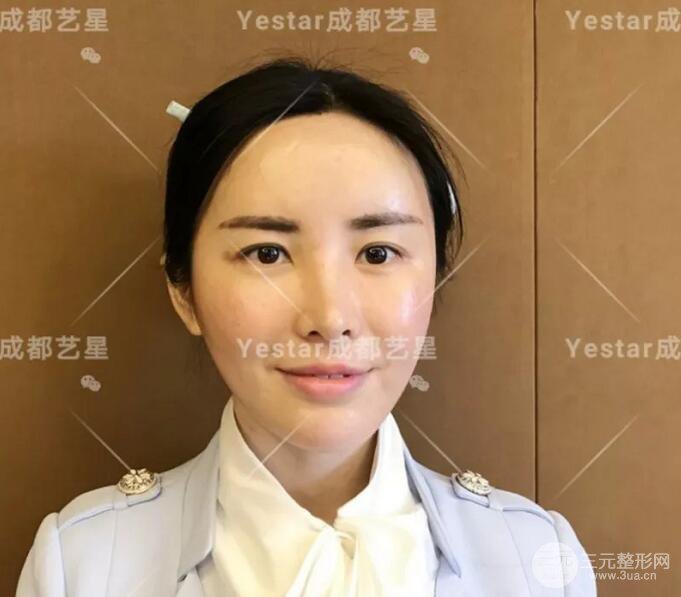 成都藝星蔡靈自體脂肪面部填充術(shù)后果記錄