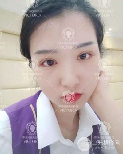 南京維多利亞切開雙眼皮+開眼角案例分享，附上前后對比圖