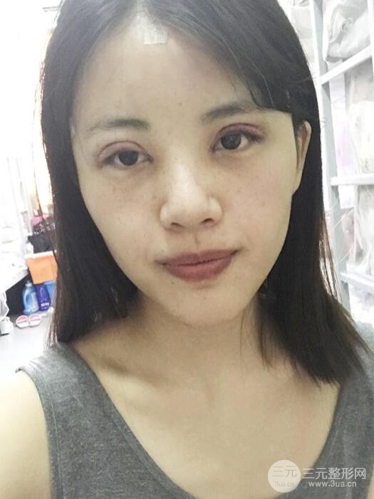 北京禾美嘉任學會自體脂肪面部填充案例分享