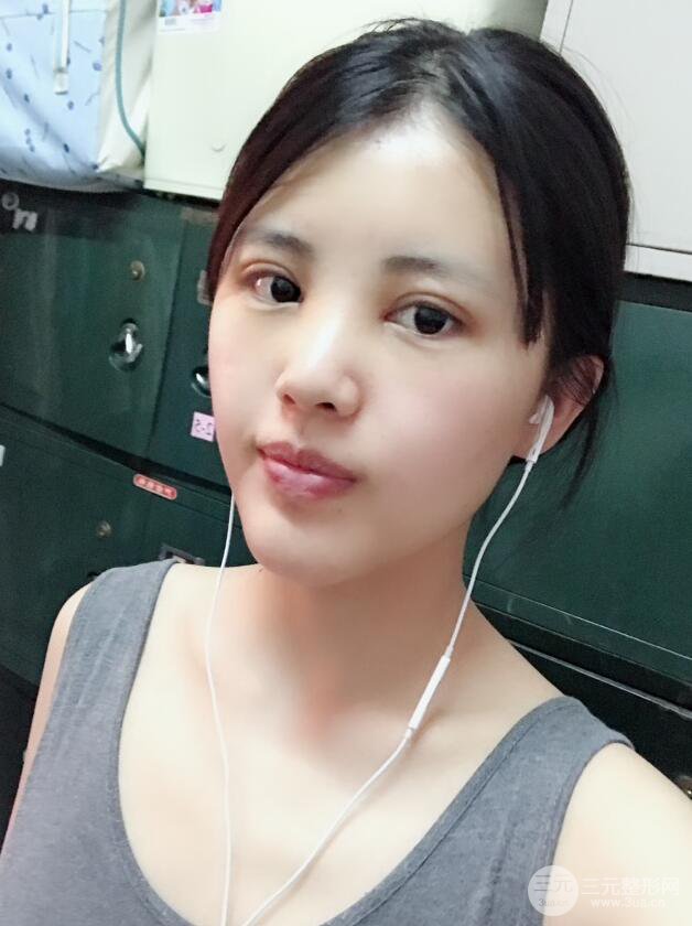 北京禾美嘉任學會自體脂肪面部填充案例分享