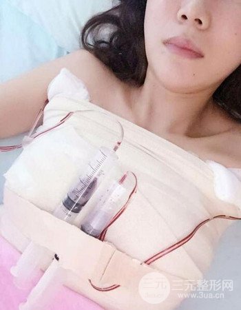 上海假體隆胸真人日記手術(shù)果分享，從A到D不是夢