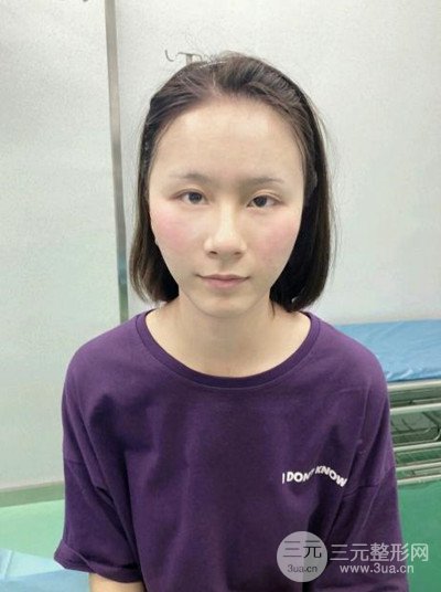 武漢伊美馨桂亮醫(yī)生自體脂肪填充面部前后對比圖恢復(fù)日記分享~