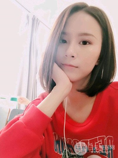 武漢伊美馨桂亮醫(yī)生自體脂肪填充面部前后對比圖恢復(fù)日記分享~