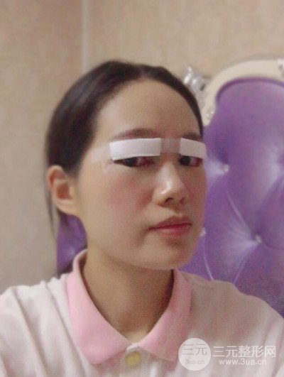 廣州晨曦切開雙眼皮恢復(fù)日記分享，附上前后對(duì)比圖