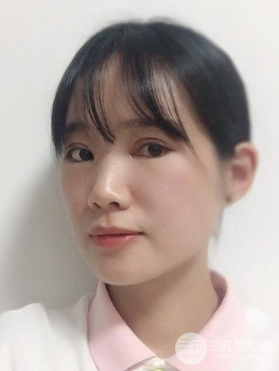 廣州晨曦切開雙眼皮恢復(fù)日記分享，附上前后對(duì)比圖