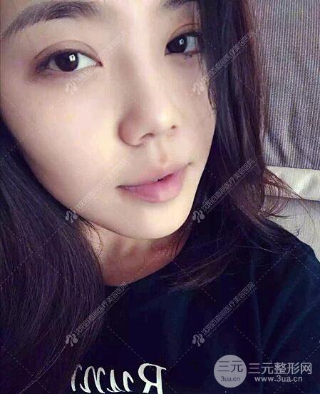 沈陽百嘉麗侯亞杰光纖溶脂瘦臉恢復日記