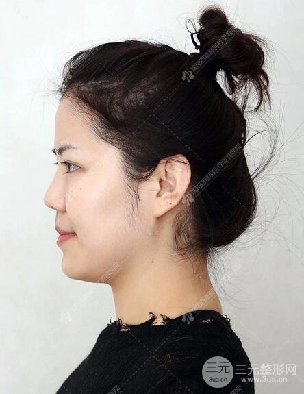 沈陽百嘉麗侯亞杰光纖溶脂瘦臉恢復日記