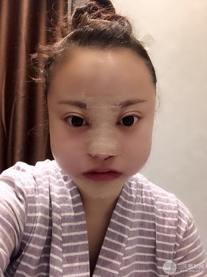 太原麗都面部吸脂+假體隆鼻案例分享，精致面部小V臉了解一下~