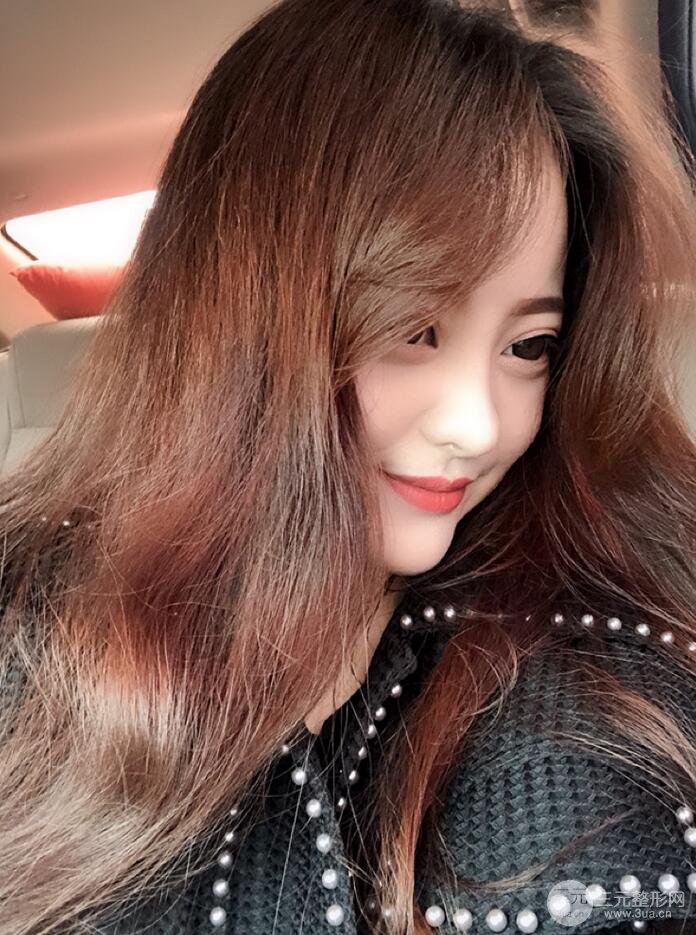 太原麗都面部吸脂+假體隆鼻案例分享，精致面部小V臉了解一下~