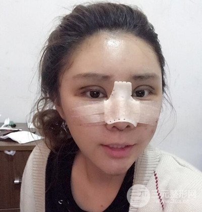 隆鼻整形+埋埋蛋白線.提升+自體脂肪全臉填充術(shù)后改頭換面！