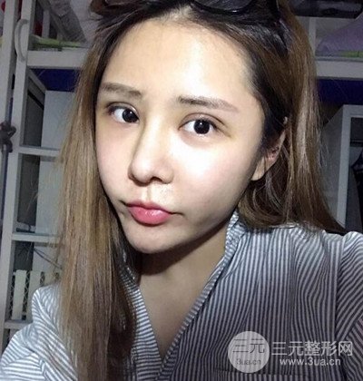 隆鼻整形+埋埋蛋白線.提升+自體脂肪全臉填充術(shù)后改頭換面！