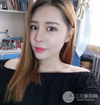 隆鼻整形+埋埋蛋白線.提升+自體脂肪全臉填充術(shù)后改頭換面！