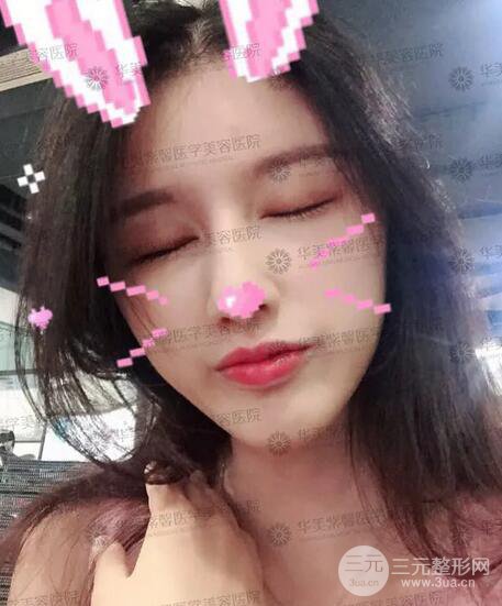 四川華美紫馨艾玉峰自體脂肪填充案例術(shù)后日記