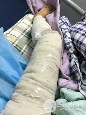 成都艾米麗潘紅偉大腿吸脂案例恢復(fù)過程分享