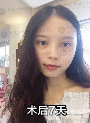 華美紫馨邱偉雙眼皮案例術(shù)后7天果圖分享