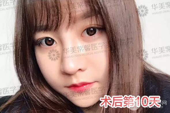 華美紫馨邱偉做的隆鼻術(shù)后10天驚人果分享！